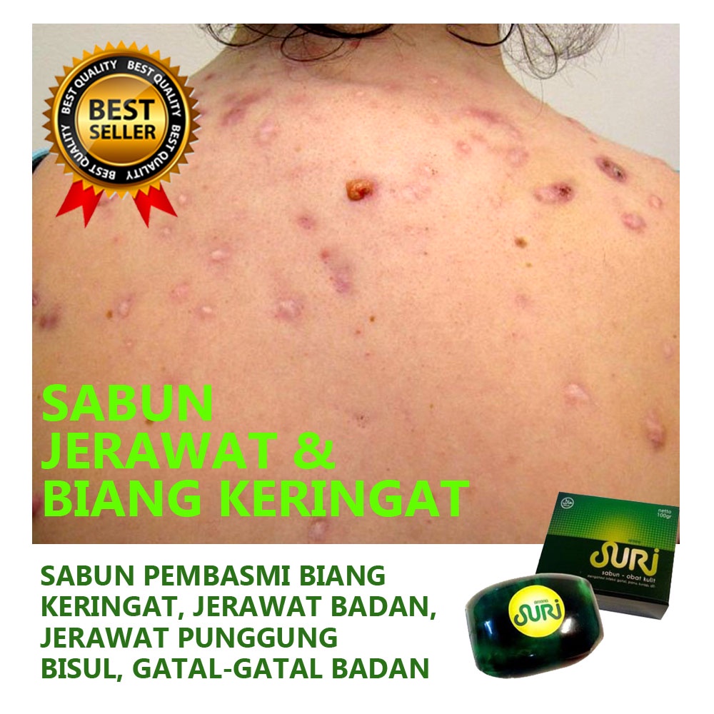 Sabun Suri - Sabun Penghilang Jerawat Biang Keringat Badan Punggung