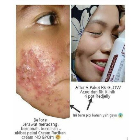 COD - RK GLOW ACNE - PAKET SKINCARE JERAWAT - MENGHILANGKAN ACNE DAN BEKASNYA - MEMBUAT MULUS