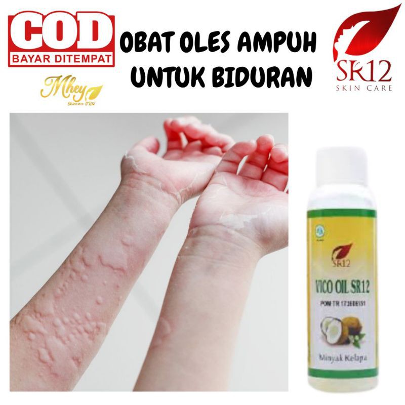 obat ampuh untuk alergi dingin dan gatal gatal lain nya BPOM vco sr12