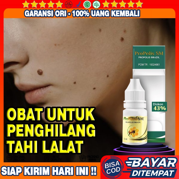 Obat Tahi Lalat Di Wajah, Penghilang Tahi Lalat, Oles  Tahi Lalat, Tahi lalat Di Leher, Di Tangan