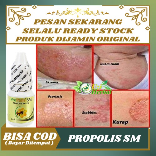 Obat Gudik Dan Gatal, Skabies, Scabies Manusia, Gudikan, Kulit Gatal Infeksi Jamur - Propolis SM