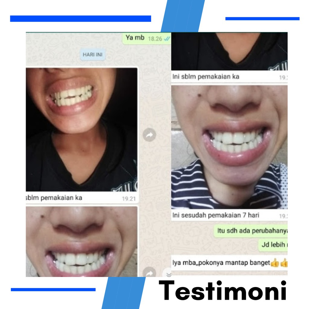 Behel Lepas Pasang Alat Perapi Gigi Retainer Perapih Gigi Tanpa Kawat Behel Teeth Trainer Alignment Perapih Gigi Anak Dan Dewasa Original