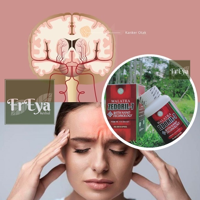 OBAT KANKER OTAK, OBAT HERBAL TUMOR OTAK (BISA COD)