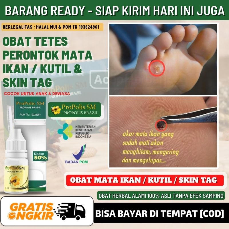 Obat Mata Ikan 100% Alami, Obat Tetes Mata Ikan Pada Anak, Obat Mata Ikan di Telapak Kaki, Obat Nyer