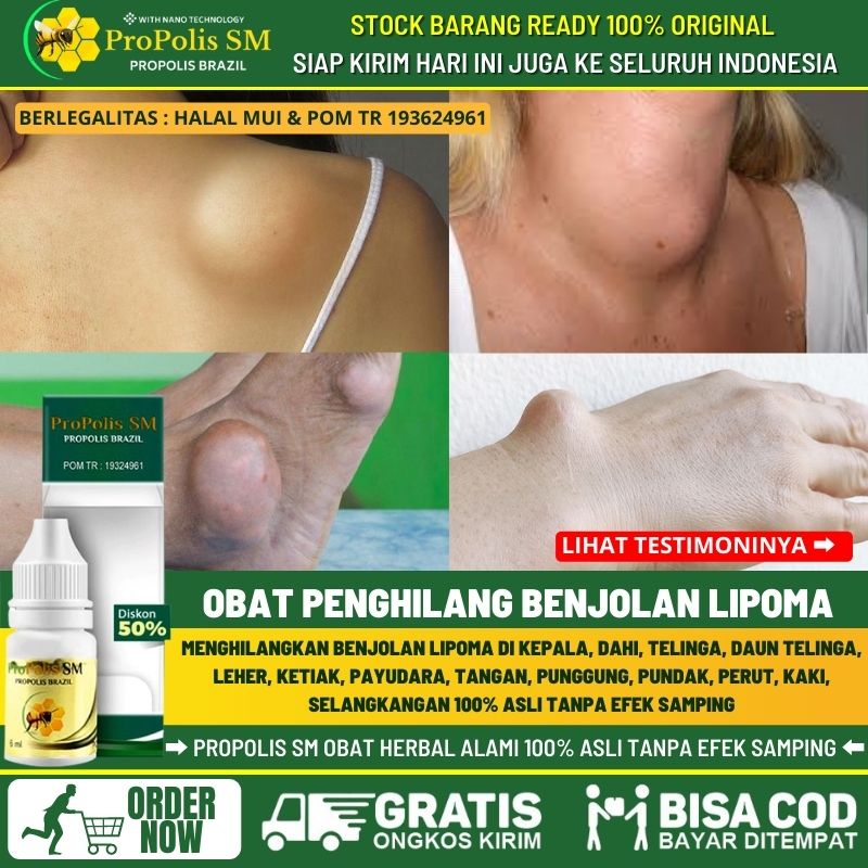 Obat Lipoma, Menghilangkan Benjolan Lipoma Secara Alami, Obat Benjolan Lipoma Terlaris, Penghilang B