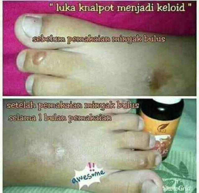 Original Minyak Bulus Sr12 Obat Masalah Kulit Borok Luka Koreng Panu Kutil Mata Ikan Keloid Shopee Indonesia