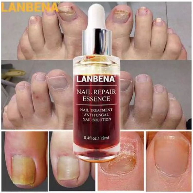 LANBENA NAIL REPAIR SERUM PERAWATAN KUKU KAKI TANGAN ANTI FUNGAL SERUM ESSENCE MEMPERBAIKI KUKU KAKI RUSAK-12ml