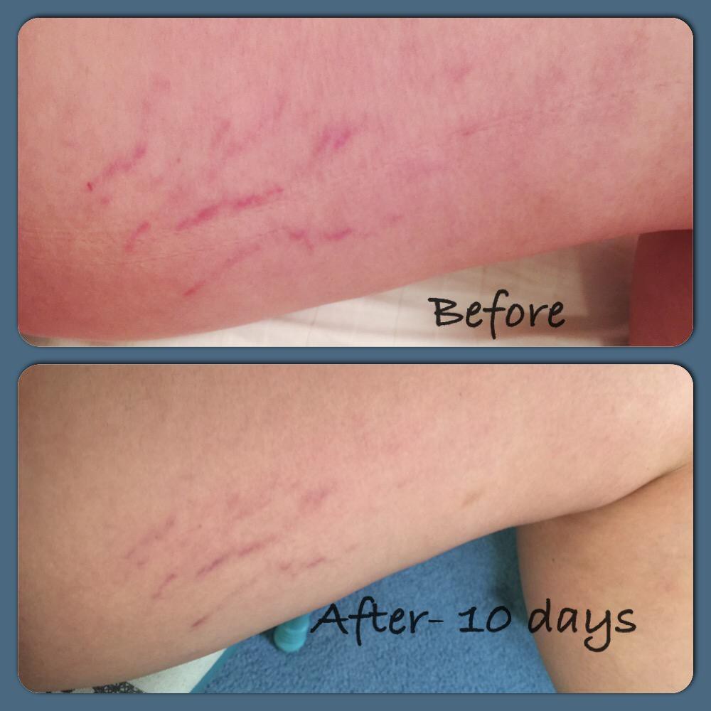 Bayar Di Tempat Cream Penghilang Stretch Mark Seleluit Vienna Stretch Mark Cream Shopee Indonesia