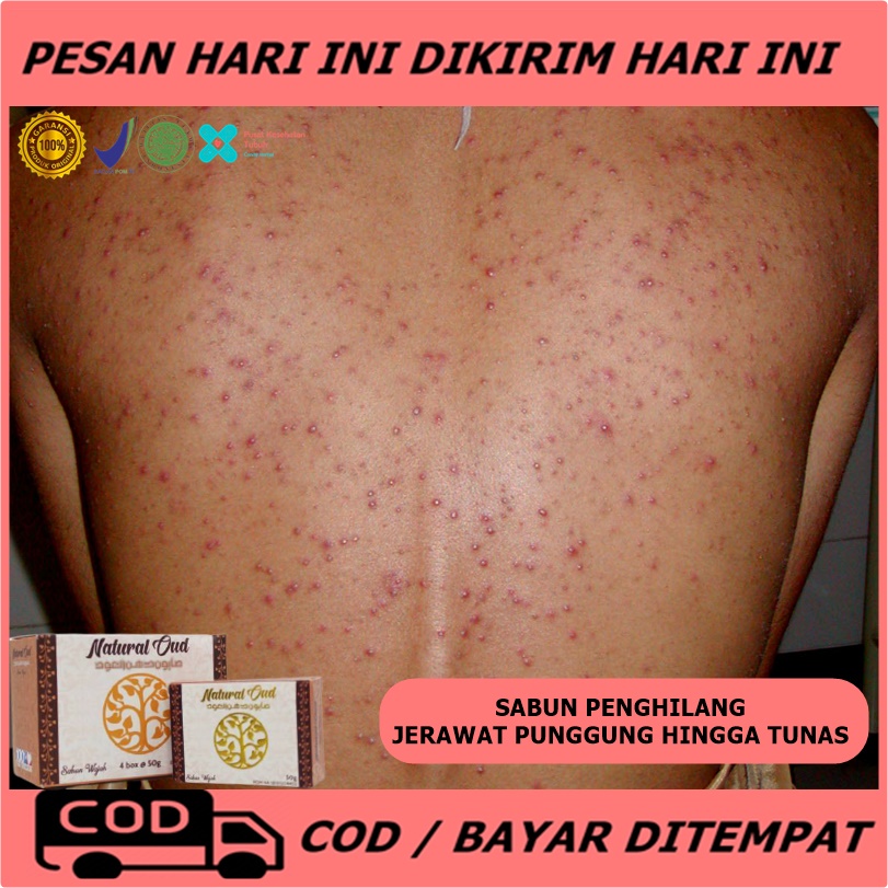 Sabun Penghilang Jerawat Punggung, Leher, Wajah - Sabun Penghilang Jerawat dan Bekas Jerawat - Obat 