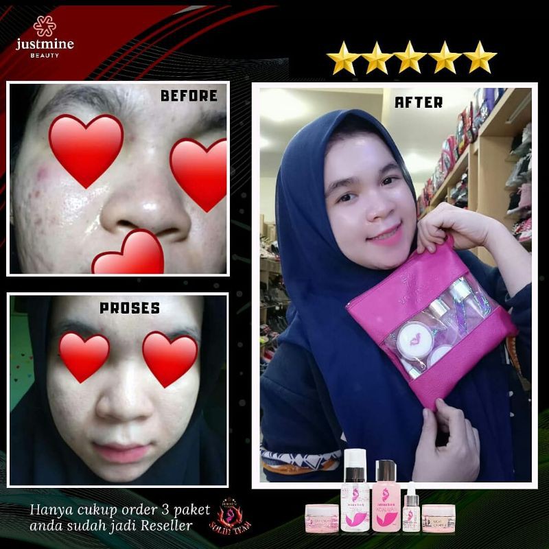 Acne Jelly (Jerawat Ringan) Isi 5 FORTE JUSTMINE BEAUTY SKINCARE