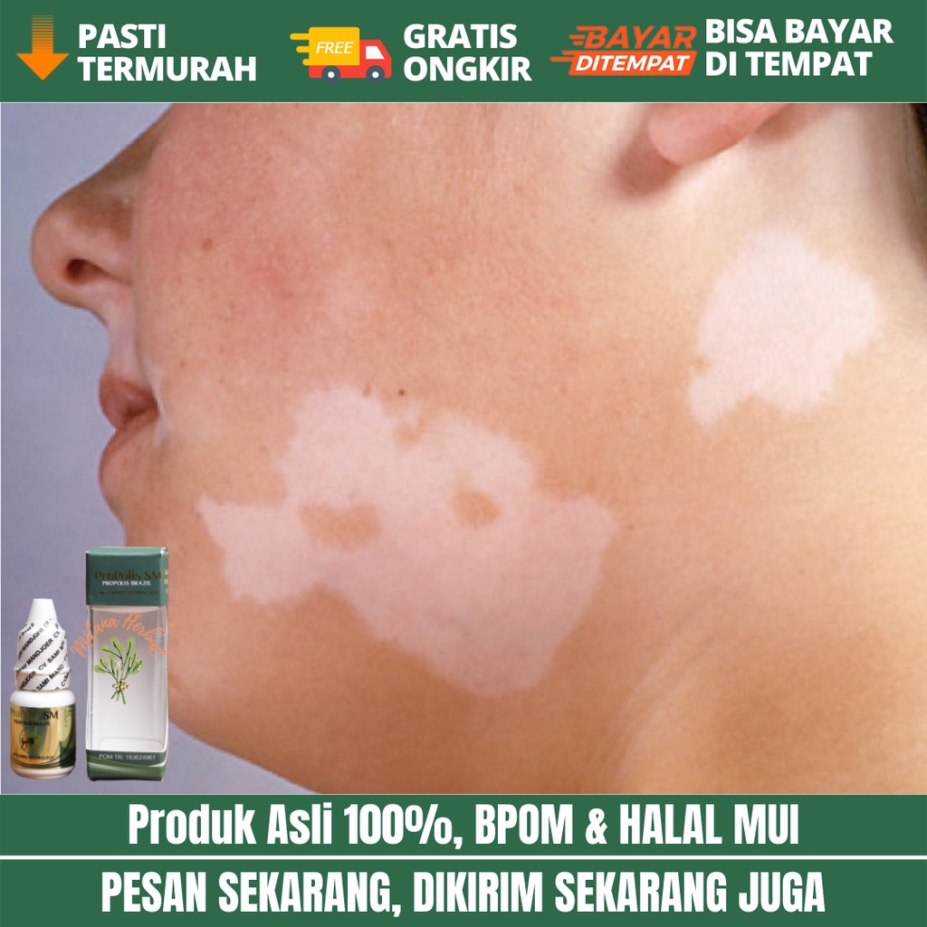 Obat Jamur Kulit Panu, Obat Penghilang Panu, Obat Herbal Panu, Obat Balas Bogo, Obat Herbal Balas Bo