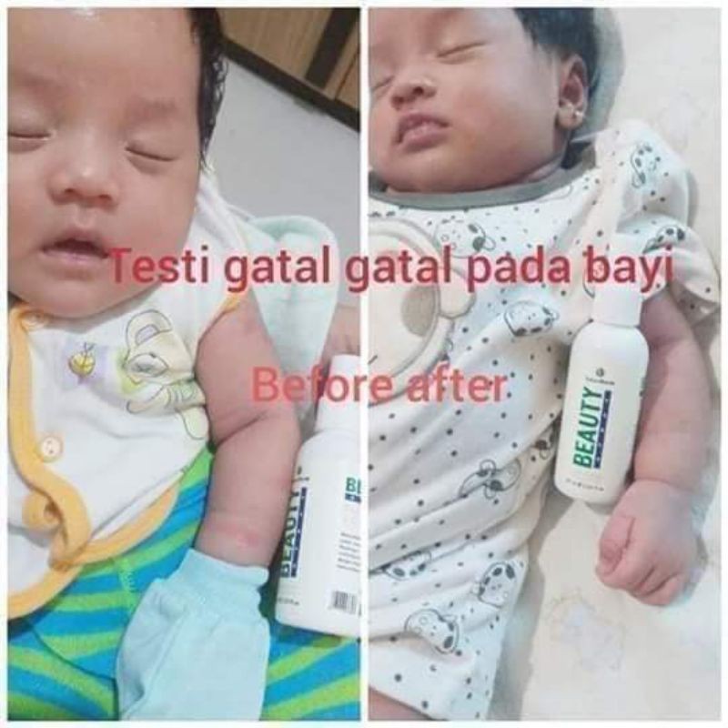 ORIGINAL NATURA BEAUTY SPRAY OBAT JERAWAT, CACAR PADA BAYI, FLEK HITAM DLL