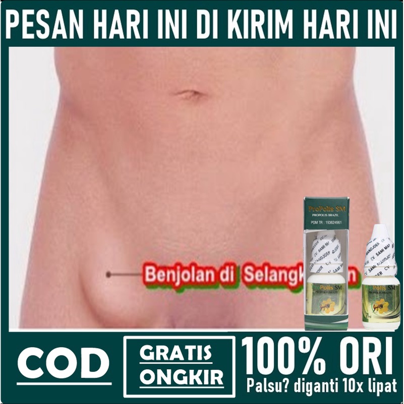 Penghancur Benjolan di Selangkangan - Obat Oles Selangkangan Sakit / Iritasi / Lecet / Gatal