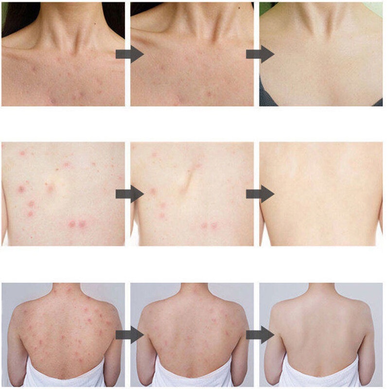 sabun jerawat badan sabun mandi jerawat sabun mandi untuk jerawat punggung 500ML Bahan herbal alami/Aroma Alami Mengatasi Kulit Jerawat/ Kering/ Gatal