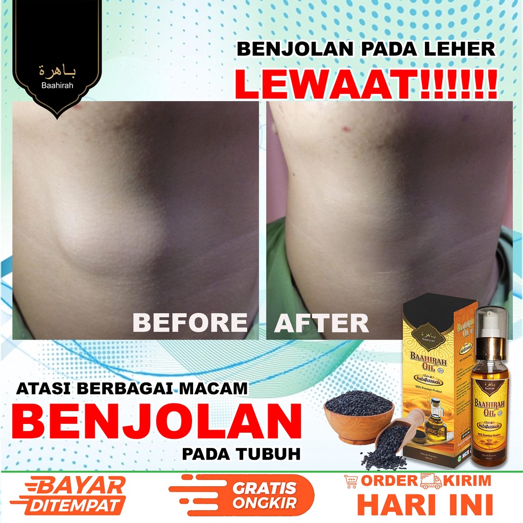 BAAHIRAH OIL FREE MADU MURNI obat segala macam benjolan