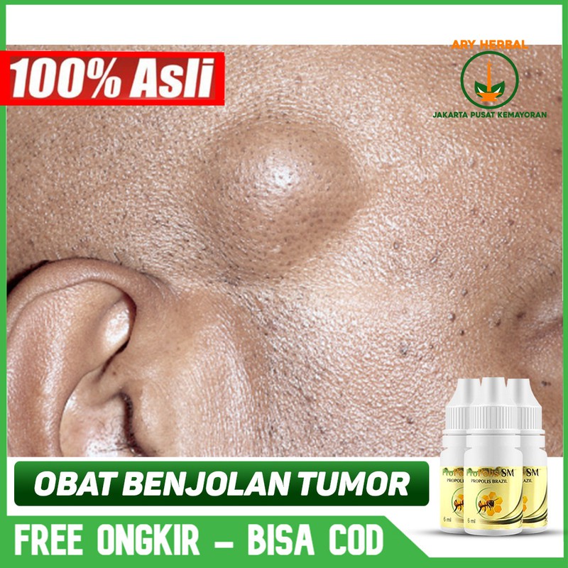 Obat Benjolan Tumor, Tumor Jinak, Leher, Telinga, Tangan -Herbal Terlaris Propolis Sm Asli Bisa COD