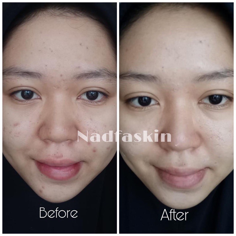 [NEW PACKAGING] Acne Night Cream 15gr &quot;Nadfaskin&quot;