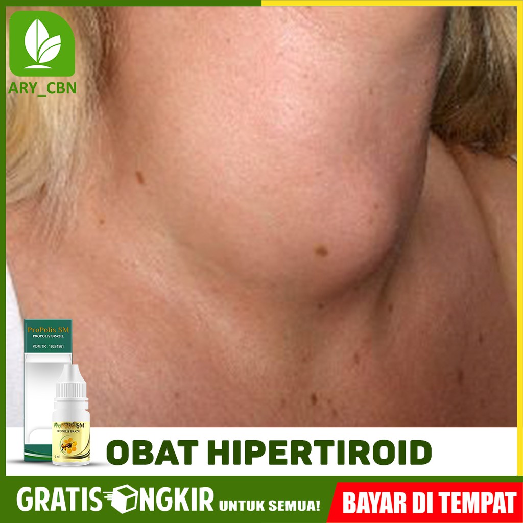

Obat Hipertiroid, Tiroid, Tyroid, Pembengkakan Di Leher Propolis SM Brazil Di CIREBON Bisa COD