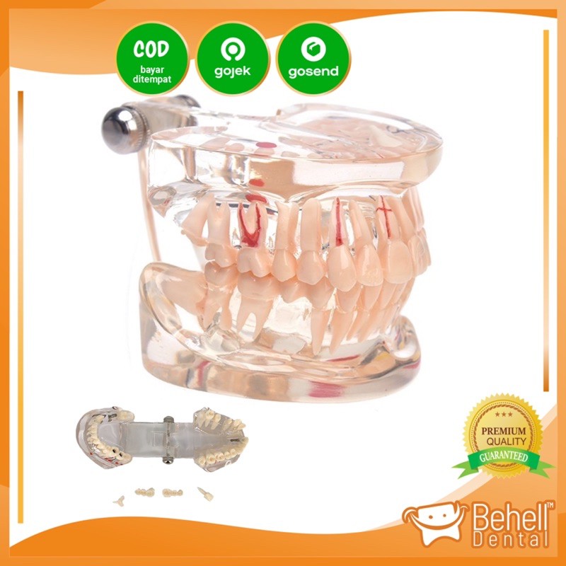 Dental Study Model Gigi Orthodontic Malocclusion PVC + Resin / Patung Gigi Phantom Bisa Di Lepas