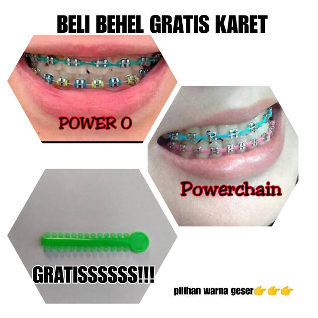 [Bisa COD] Behel Lepas pasang // Behel Fashion Lepas Pasang // GRATIS KARET PROMO