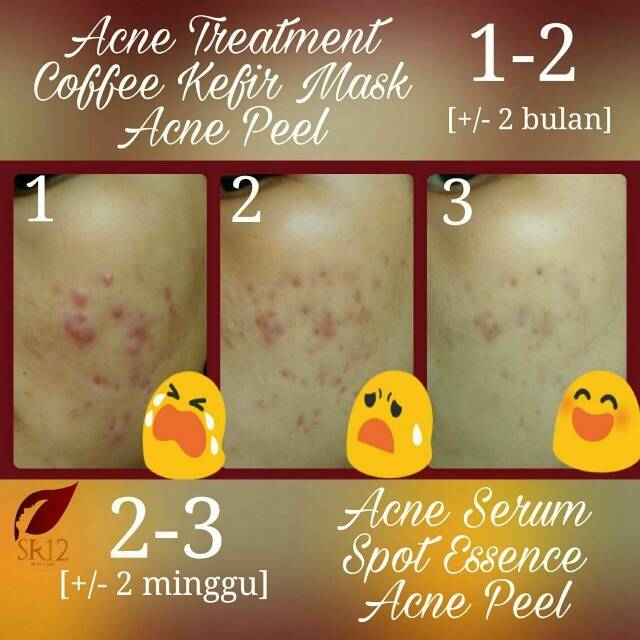 ACNE TREATMENT CREAM / KRIM JERAWAT SEDANG SAMPAI BERAT YANG DISERTAI RADANG INFLAMASI