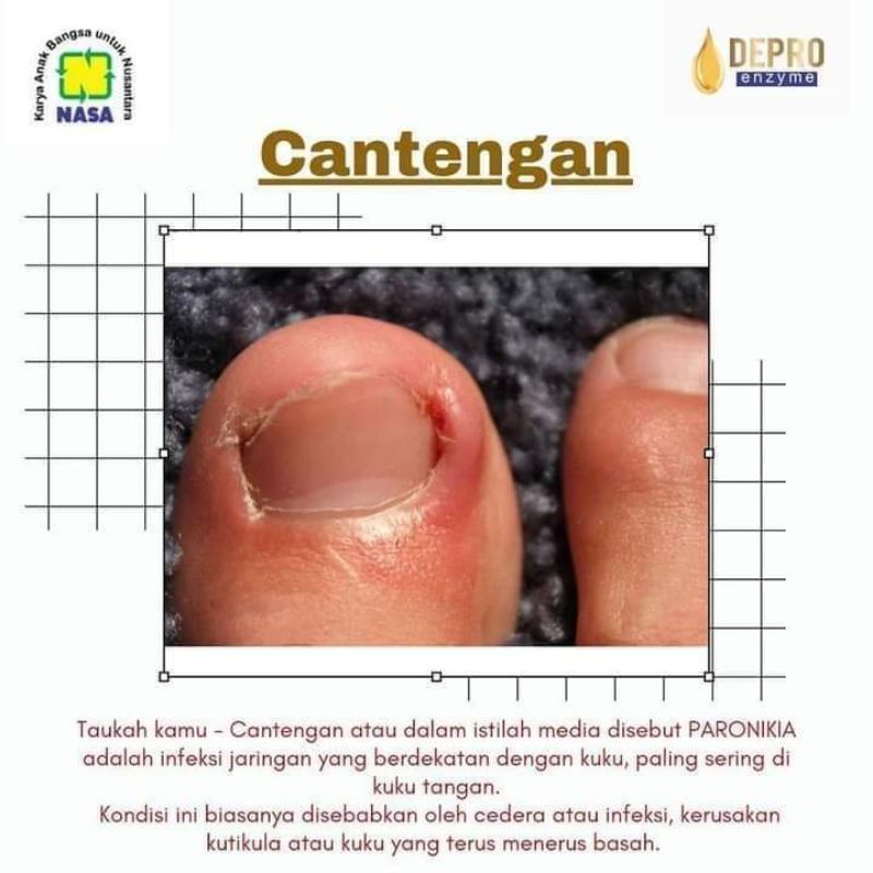 Obat Cantengan Jempol Kaki Paling Ampuh Obat Tetes Tangan Kuku Cantengan BPOM Obat Cantengan Jempol 