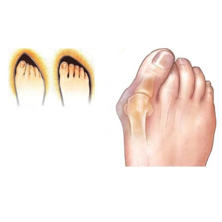 bunion pemisah dan pelurus jari kaki 009