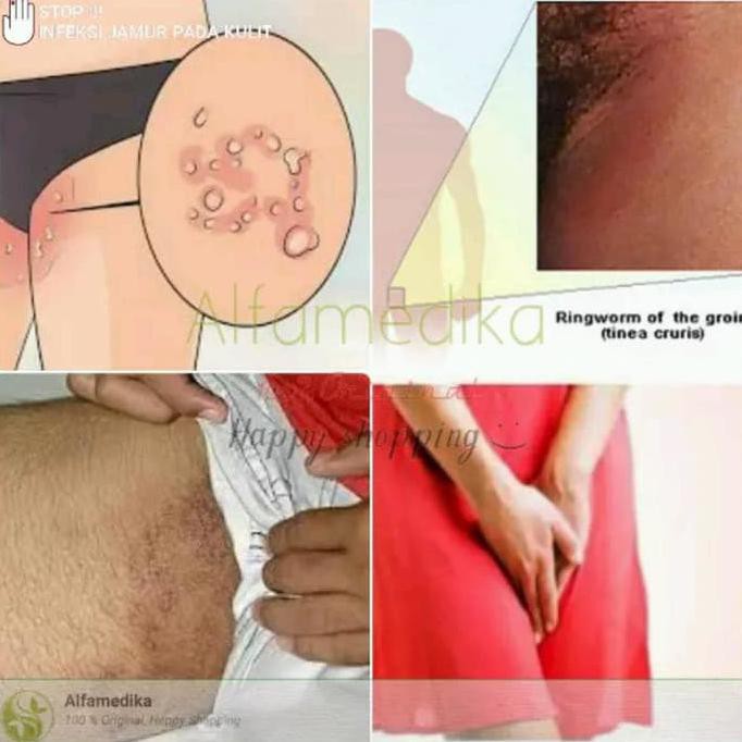 Salep Kulit Obat Cina / China Anti Jamur Panu Kadas Kudis Kurap Kutu