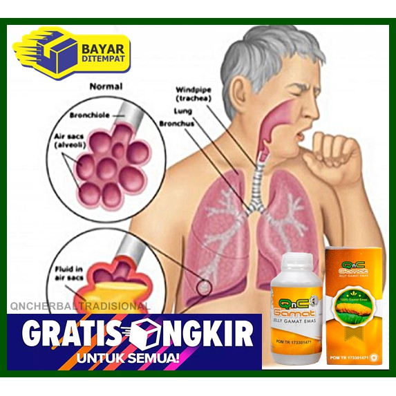 Obat Herbal TBC, TB Paru Batuk Berdahak Radang Paru Paru Infeksi Paru Paru Basah Cairan Di Paru Paru