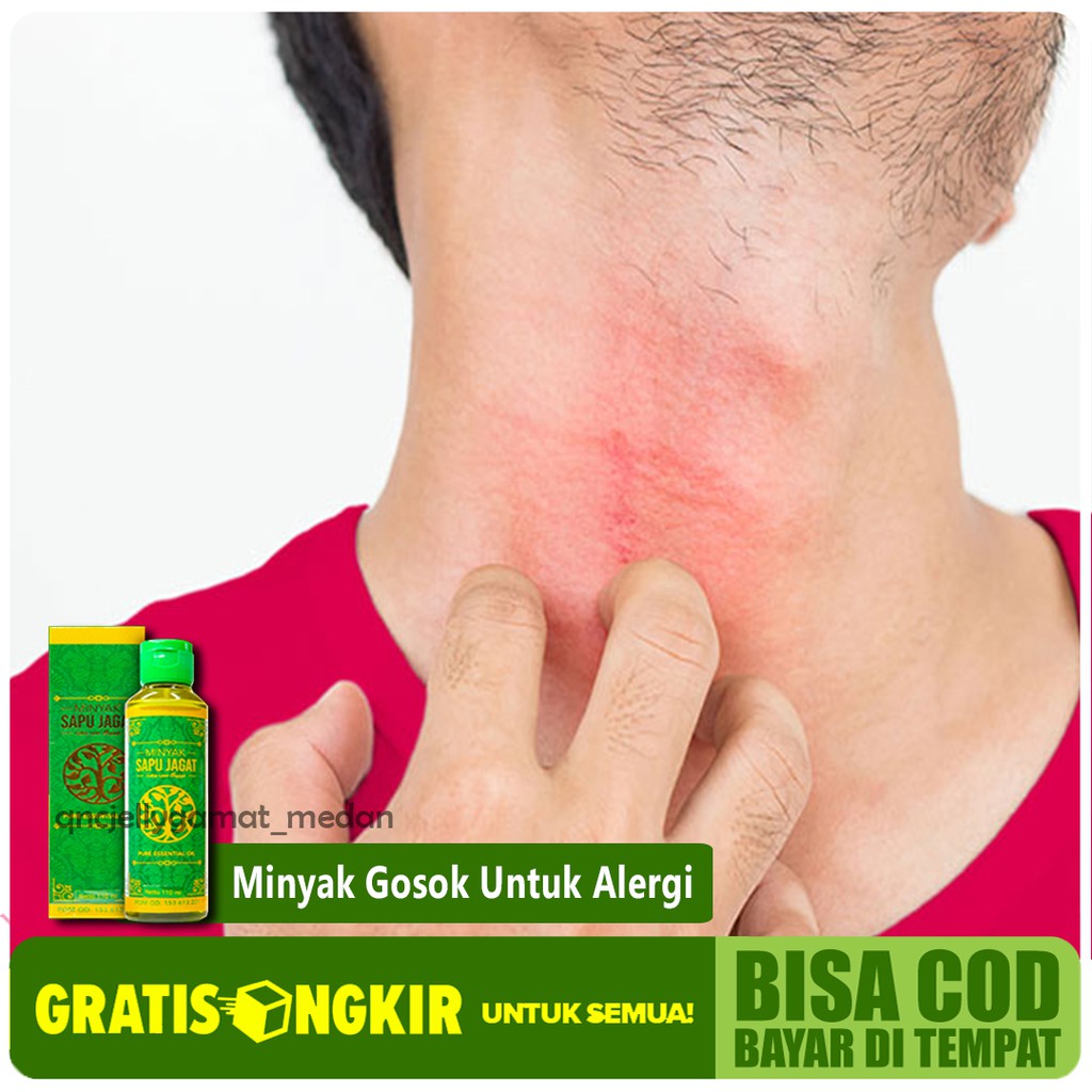 Minyak Gosok Herbal Untuk Alergi Gatal Ruam Di Kulit Kulit Gatal Gatal Minyak Sapu Jagat Asli 100 Shopee Indonesia