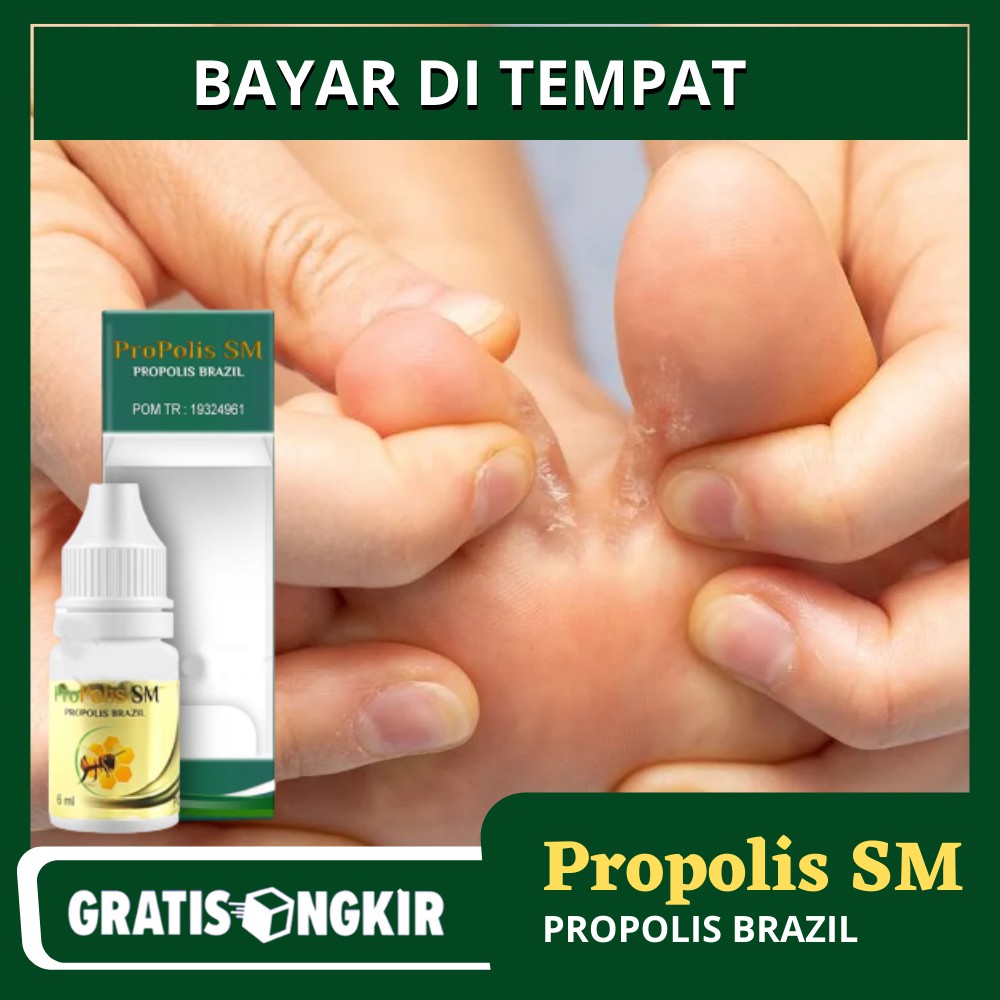 Obat Kutu Air Obat Kutu Air Parah Obat Kutu Air Pada Telapak Kaki Propolis Sm Shopee Indonesia