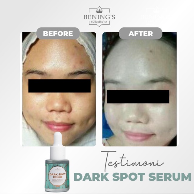 BENING'S SERUM DARK SPOT | MENGATASI FLEK, MELASMA &amp; MENCERAHKAN | FREE GIFT SIAP KIRIM SELURUH INDONESIA