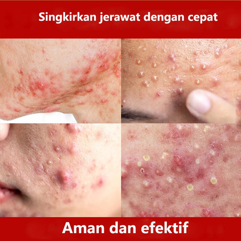 acnecare Krim Wajah Berjerawat obatjerawat 50g herbal ekstrak krim jerawat  halal  menghilangkan bekas jerawat  bekas jerawat  memutihkan kulit