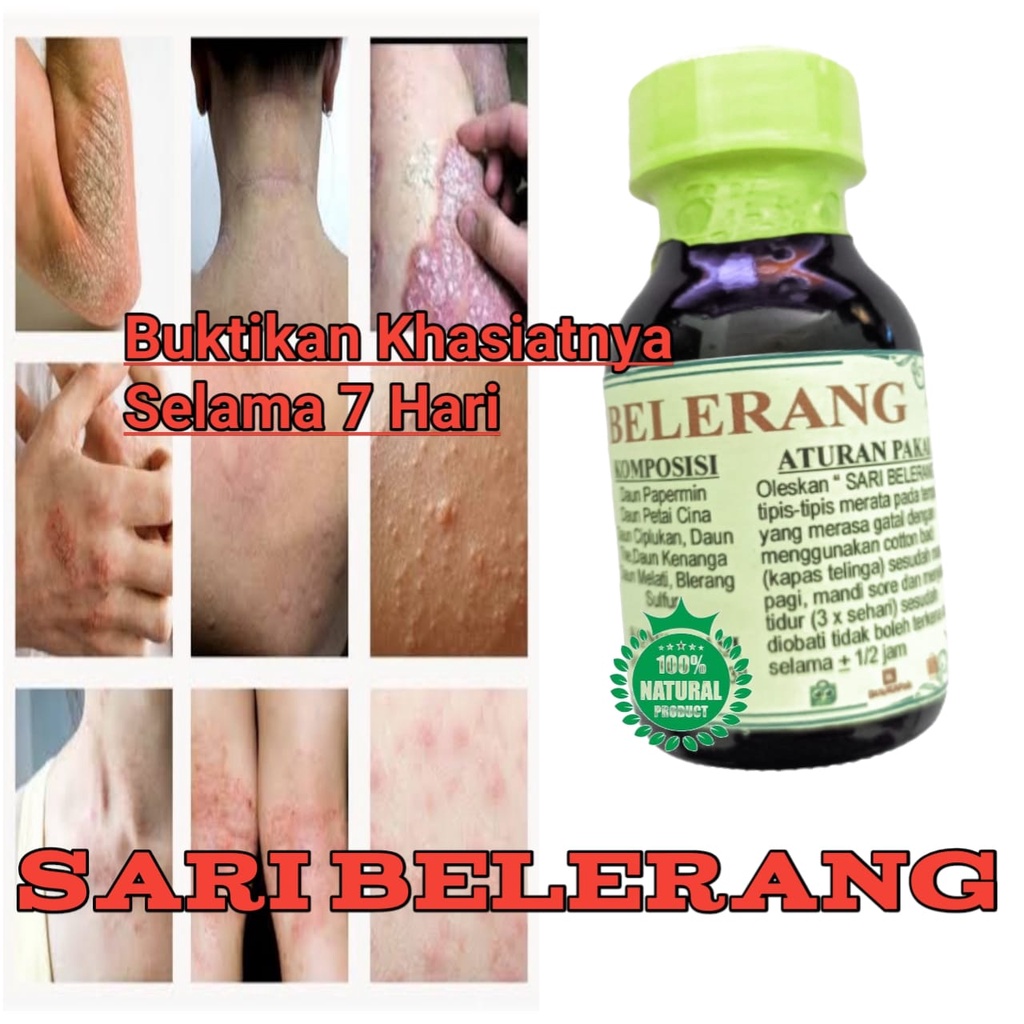 Obat Gatal Kulit Alergi Selangkangan Belerang Cair Ampuh