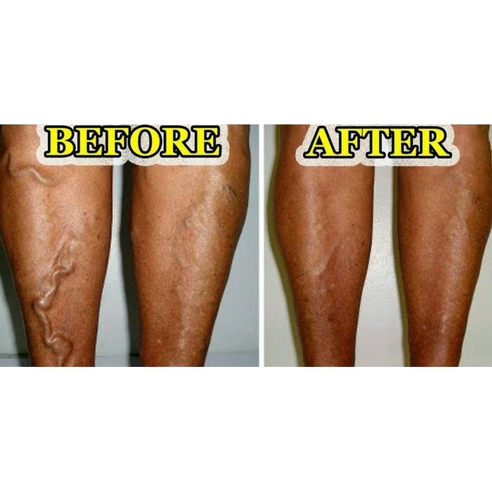 Obat varises Salep penghilang Varises Tanpa Operasi - Varicose Veins Treatment Cream