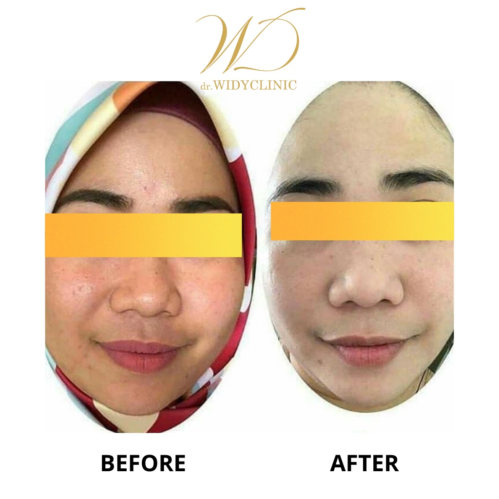 Dr Widy Clinic Whitening Skincare | Paketan Pencerah &amp; Glowing Untuk Semua Jenis Kulit Flek Melasma Bekas Jerawat | BPOM &amp; Halal MUI Formulasi Dokter