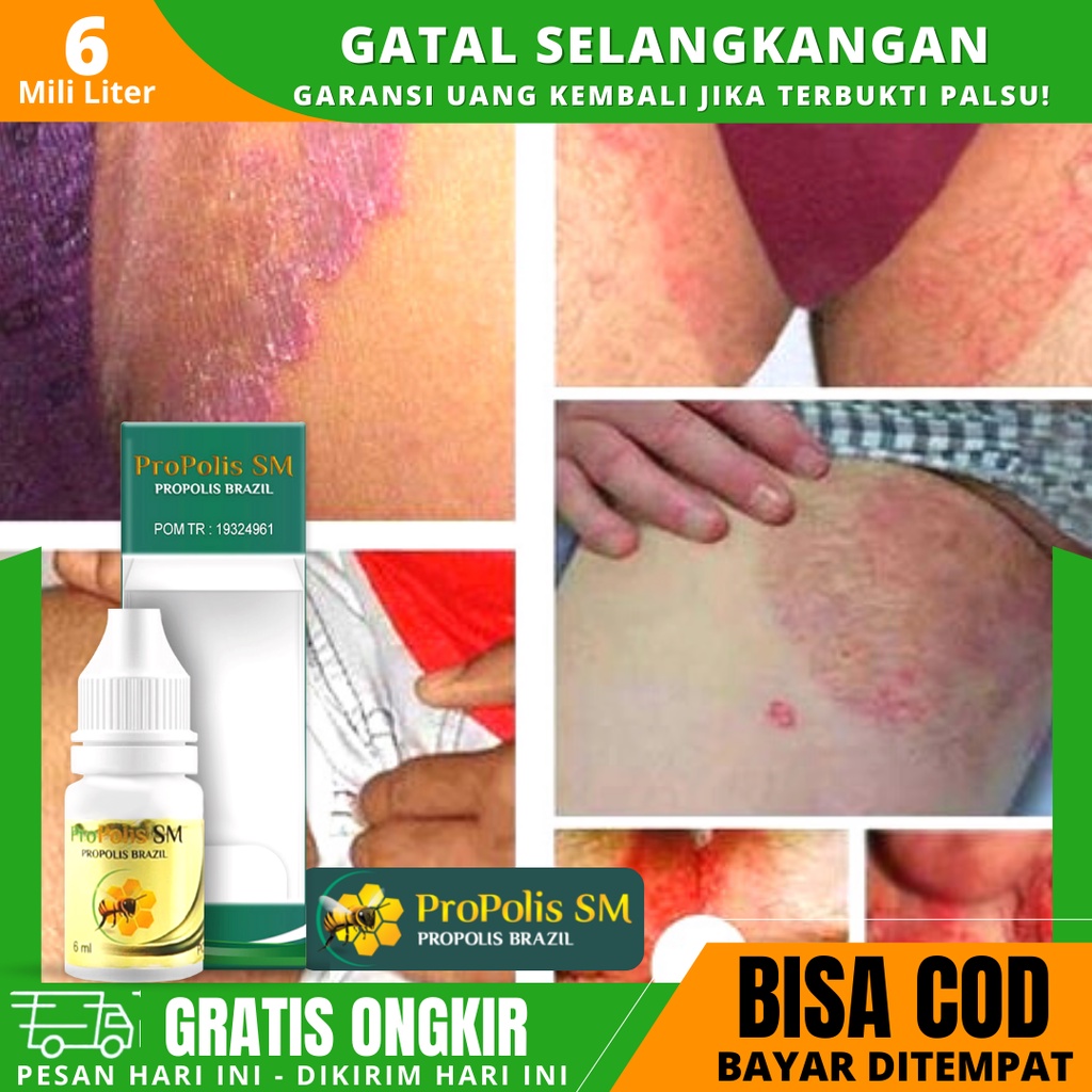 Obat Gatal Pada Selangkangan Wanita Saat Hamil Iritasi Pada Selangkangan Lebam Merah Propolis SM