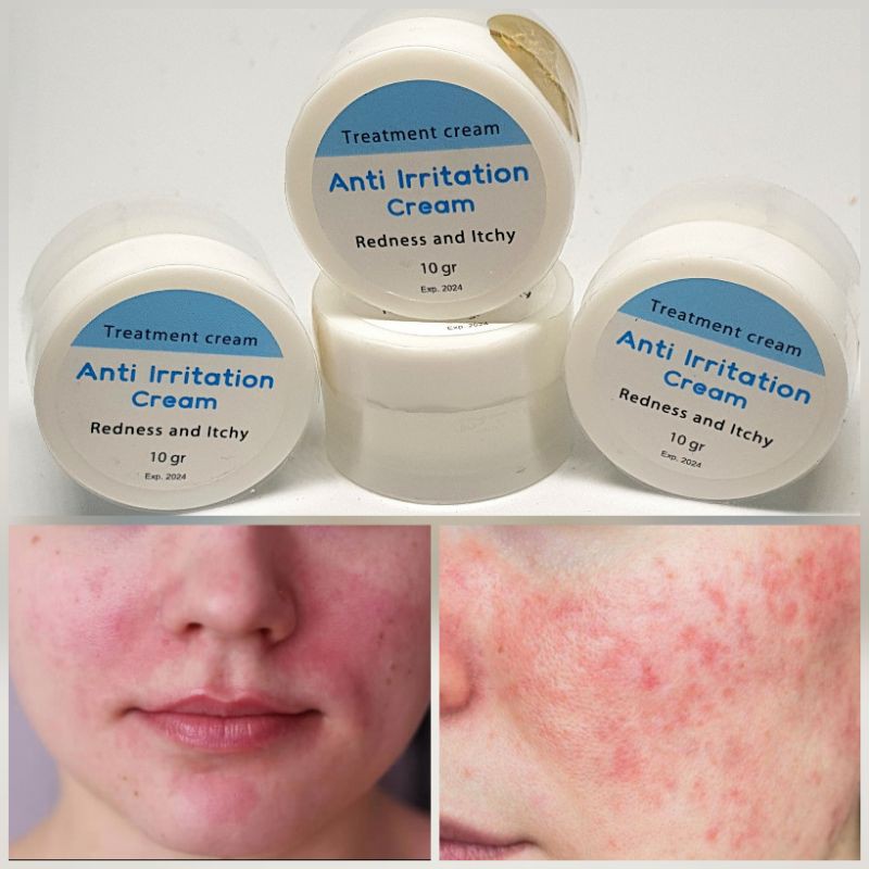 Anti Iritasi Anti Alergi Cream Farmasi Perawatan Wajah Iritasi Cream Iritasi Gatal Gatal Shopee Indonesia
