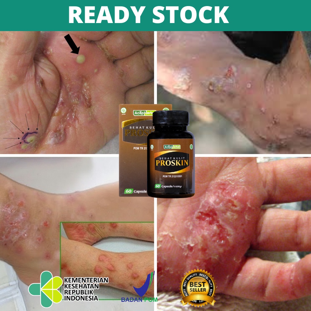 Obat Budug Scabies, Obat Koreng Bernanah, Gatal Bernanah, Obat Koreng Bernanah Di Kaki, Darah Manis,