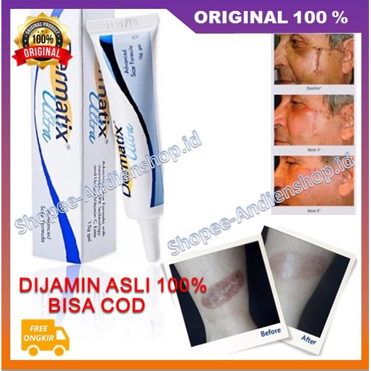 Dermatix Ultra Gel Penghilang Bekas Luka / Keloid ANTI SCAR Stretchmark Perbaikan Kulit Terbukti Amp