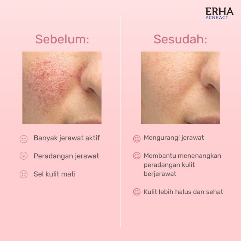 Erha Acne Spot Gel