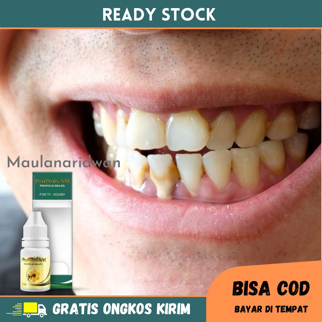 Obat Perontok Karang Gigi, Plak Gigi, Sakit Gigi Berlubang, Obat Sakit Gigi Keropos - Propolis SM