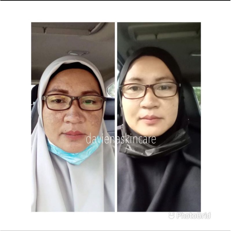 Daviena Skincare Paket Gold Series Davienaskincareofficial Davina Devina Lampung Surabaya Jakarta Pencerah Pemutih Flek Wajah Glowing Bpom Daviena Skincare-5