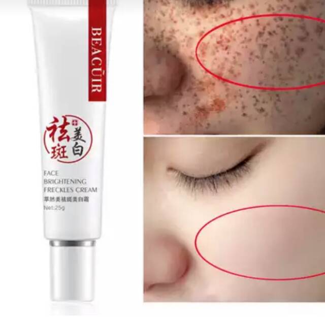 Cream penghilang flek