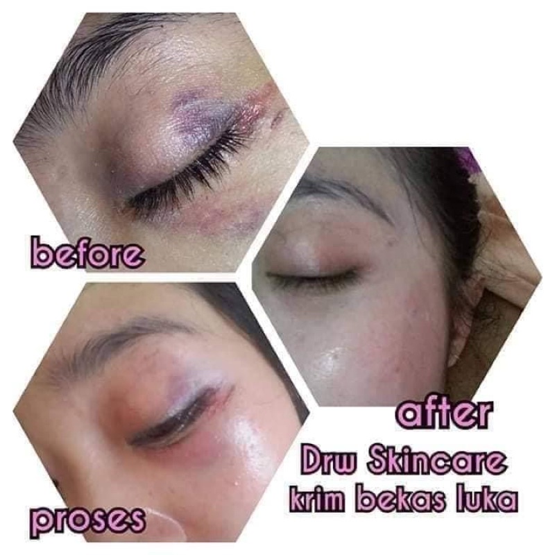 ByuSa DRW Skincare Dermabright / Krim Bekas Luka