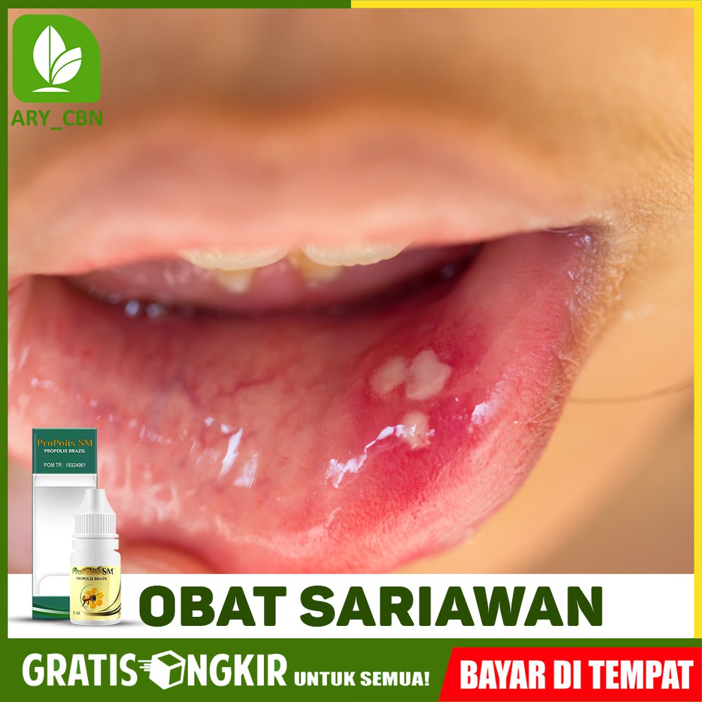 

Obat Sariawan Untuk Anak Anak Bayi Dewasa Aman Herbal Propolis SM Brasil Bisa COD Di Cirebon