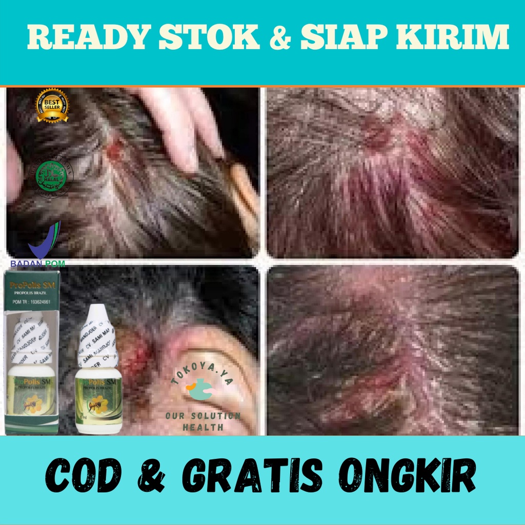 Obat Penghilang Ketombe Berkerak, Obat Tetes Penghilang Ketombe Berkerak Parah, Obat Penghilang Gata