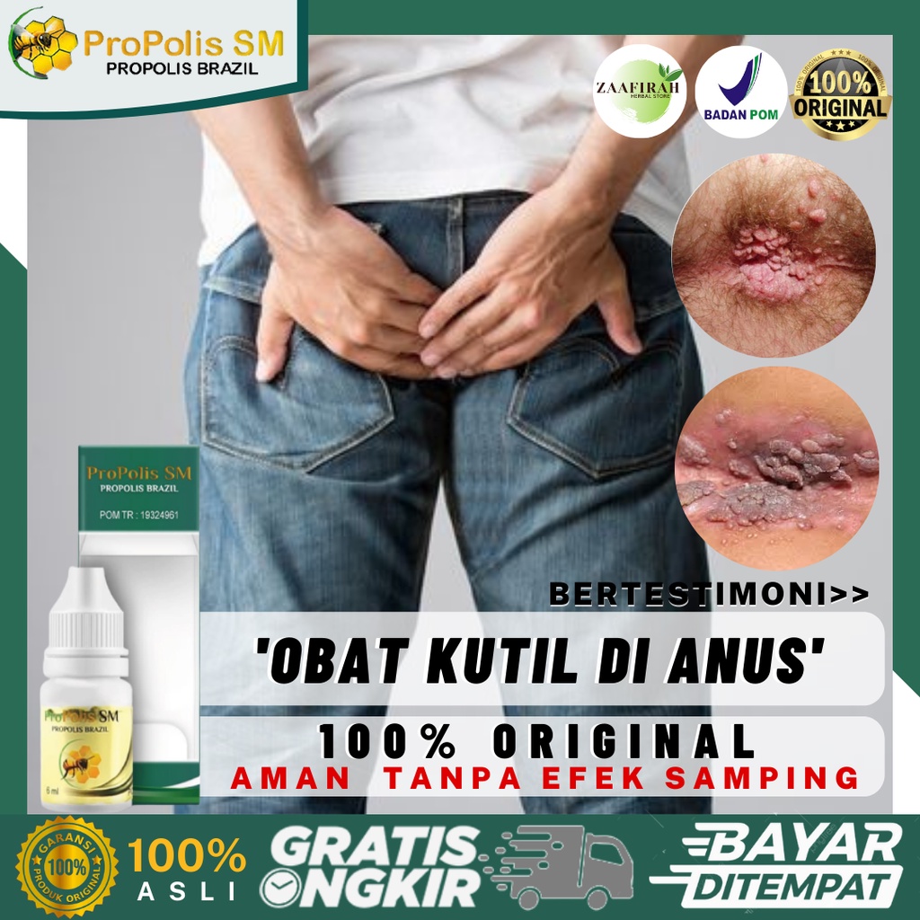 Obat Kutil Anus - Benjolan Kecil Di Anus - Kutil Di Lubang Anus - Daging Jadi - Papiloma - Jengger A
