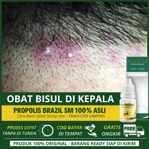 Obat Bisul Di Kepala, Menghilangkan Benjolan Di Kepala, Obat Bisul Anak, Salep Benjolan Di Kulit Kep