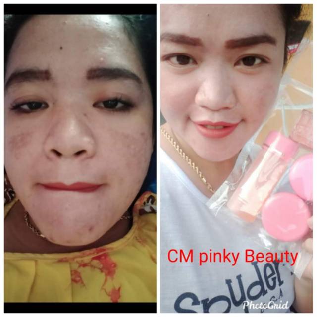 Paket Flek Jerawat Pinky Beauty Skincare Ori By Hj Imelda Yunus Shopee Indonesia